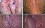 Симптомы и лечение микропапилломатоза половых губ у женщин