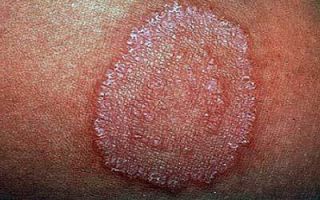 Паховый дерматит: причины появления, симптомы и особенности лечения