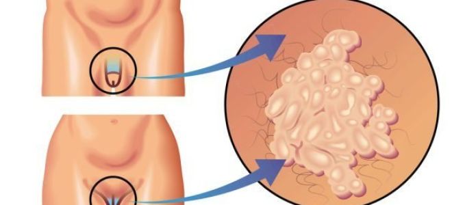 Причины возникновения и лечение впч 45 типа у женщин