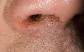Причины и лечение экземы на носу и других частях лица