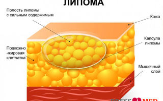 Атерома: причины возникновения и лечение атероматоза