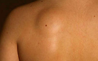 Причины и лечение кисты (атеромы) на спине под кожей