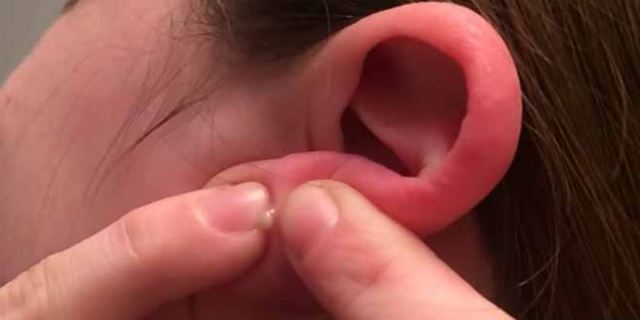 Причины развития прыщей на мочке уха