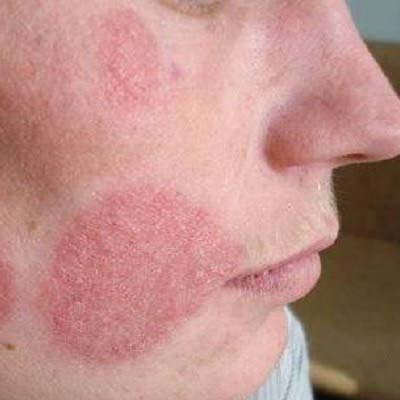Эффективные мази от себорейного дерматита на лице и голове