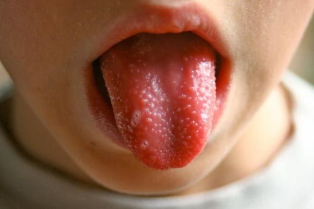 Причины и лечение наростов на корне и кончике языка