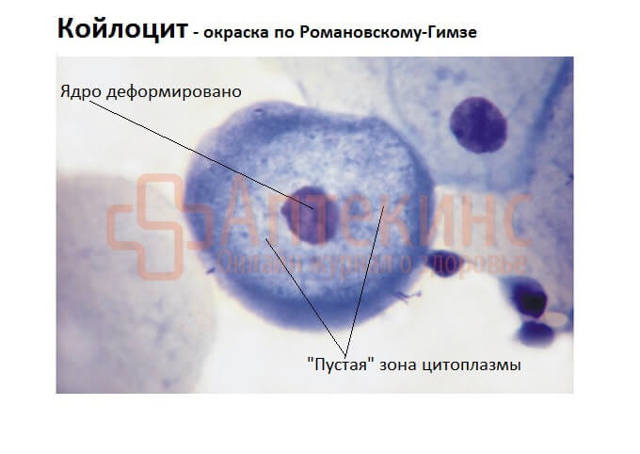 Генотипирование вируса папилломы человека, симптомы и лечение