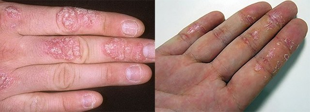 Как вылечить псориаз на руках и надолго избавиться от его симптомов
