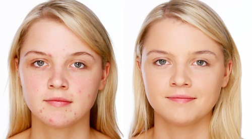 Применение в косметологии хлоргексидина от прыщей для лица