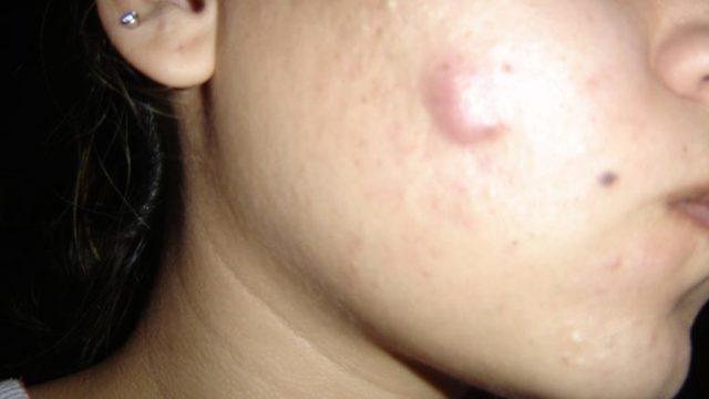 Причины появления подкожных прыщей на лице и их лечение