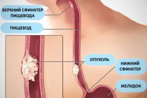 Признаки и причины папилломы в горле и лечение от заболевания