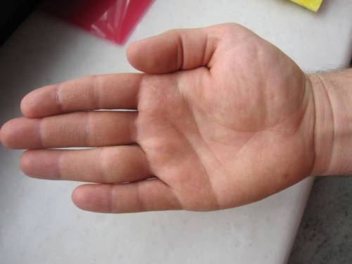 Значение родинки на пальцах правой и левой руки