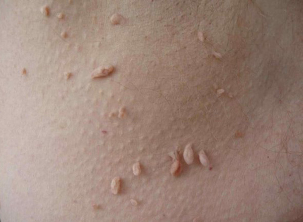 От чего появляются папилломы на коже и способы лечения впч