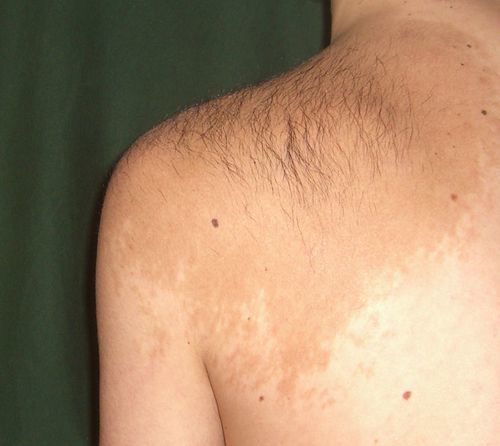 Причины появления темных пигментных пятен на спине