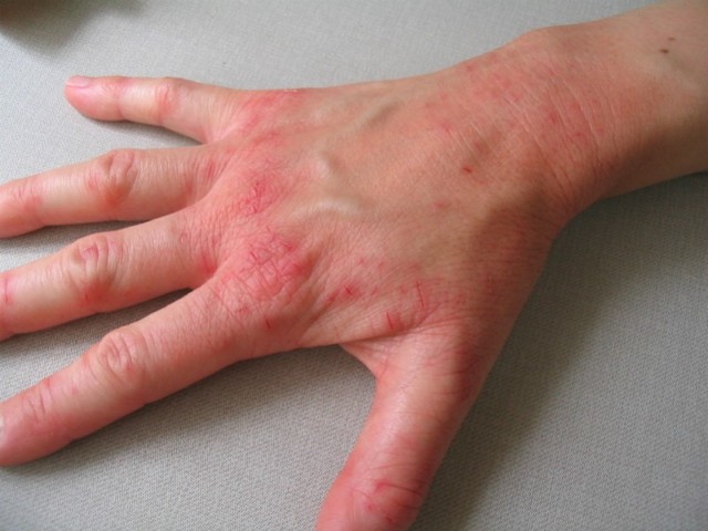 Дерматит на руках: причины, симптомы и лечение