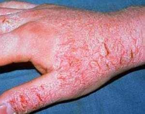 Кремы и мази в лечении аллергического дерматита