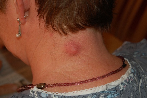 Шишка на плече под кожей: виды, причины и лечение