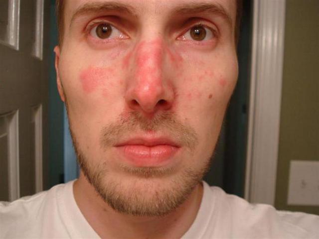 Симптомы и лечение себорейного дерматита на лице