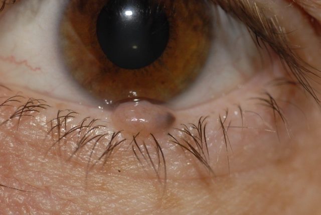 Причины и лечение папилломы на слизистой глаза разными методами