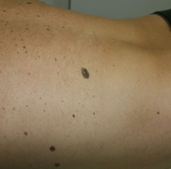 Причины возникновения кератом на коже и их лечение