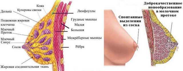 Лечение внутрипротоковой папилломы молочной железы