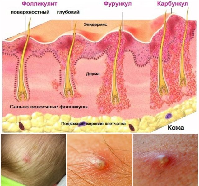 Внутренний фурункул: причины образования чирьев под кожей и лечение