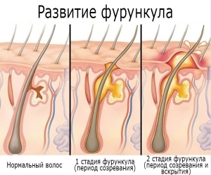 Фурункул на половой губе: причины, симптомы и лечение гнойника