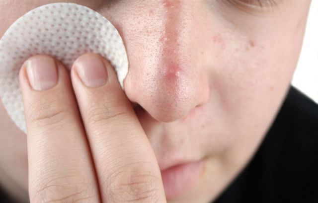 Причины появления и лечение прыщей на носу у женщин