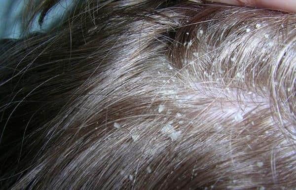 Лечение лекарственными средствами сухой себореи на коже головы