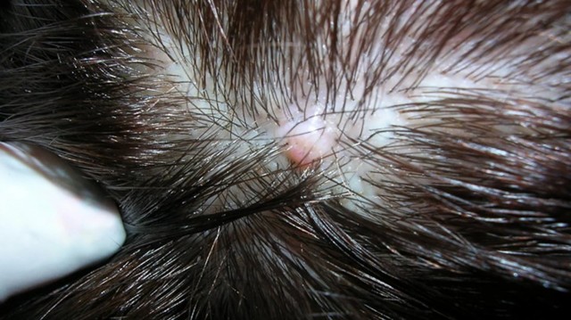 Удаление атеромы (жировика) на волосистой части головы