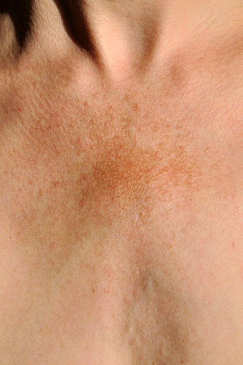 Пигментные пятна и причины их появления на шее, лечение