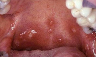 Причины, симптомы и лечение герпеса во рту и на губах у взрослых