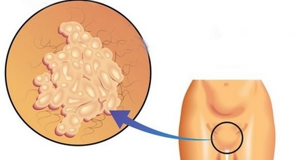 Папилломатоз вульвы: причины и удаление папиллом во влагалище
