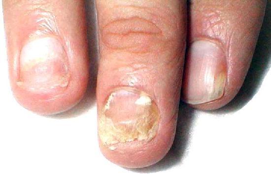 Грибок на пальцах рук: причины, симптомы и лечение