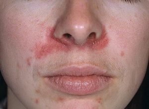 Симптомы и лечение себорейного дерматита на лице
