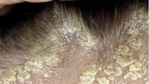 Причины, симптомы и лечение дерматита на коже головы