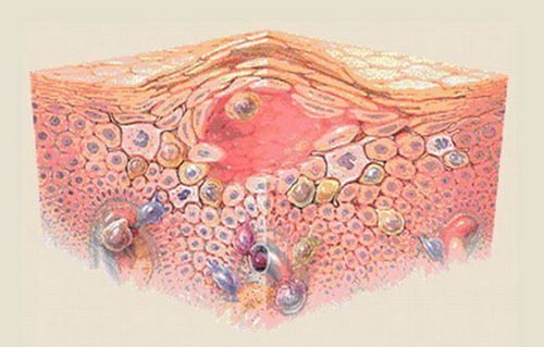 Причины и лечение экземы на носу и других частях лица