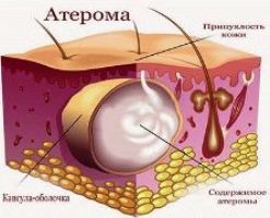 Причины появления атеромы на лице, лечение кисты сальной железы