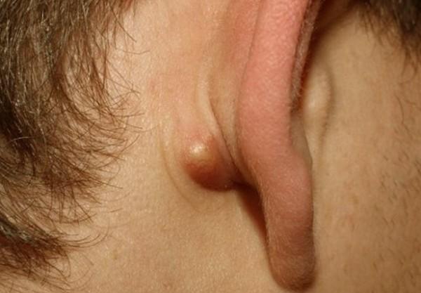 Причины воспаления сальных желез и лечение атеромы за ухом