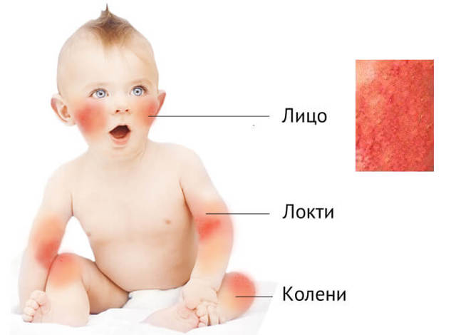 Кремы и мази при атопическом дерматите у детей