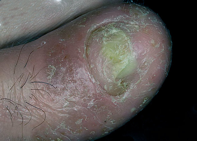Как лечить псориаз на пальцах ног, стопе и голени