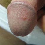 Причины и методы лечения псориаза на половом члене у мужчин
