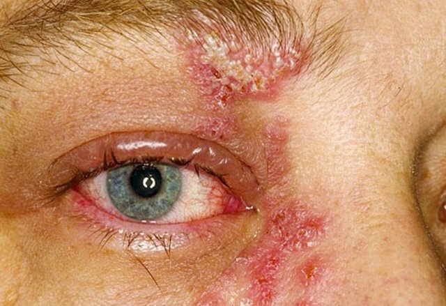 Герпес в глазу: симптомы инфекции и лечение