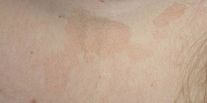 Цветной лишай на коже: причины, симптомы и лечение в домашних условиях