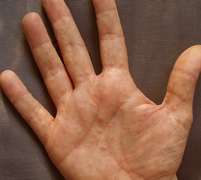 Причины возникновения и лечение экземы кистей рук