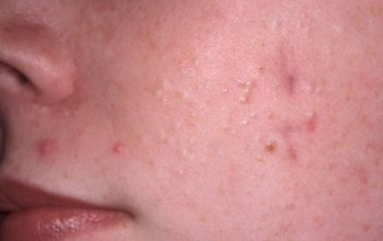 Причины появления прыщей на щеках у женщин и способы лечения