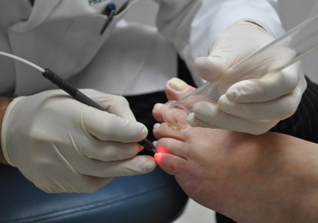 Лечение вирусной бородавки на пальце ноги