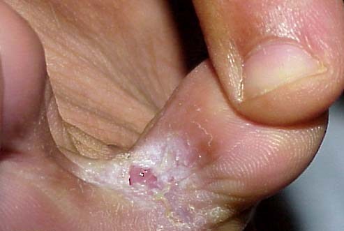 Как выглядит грибок на пальцах ног