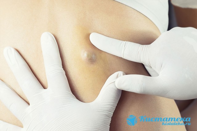 Причины и лечение кисты (атеромы) на спине под кожей