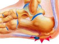 Больно наступать: лечение уплотнения на подошве ноги