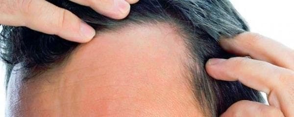 Лечение лекарственными средствами сухой себореи на коже головы